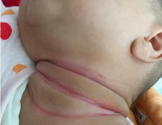孩子淹脖子有办法可以预防吗