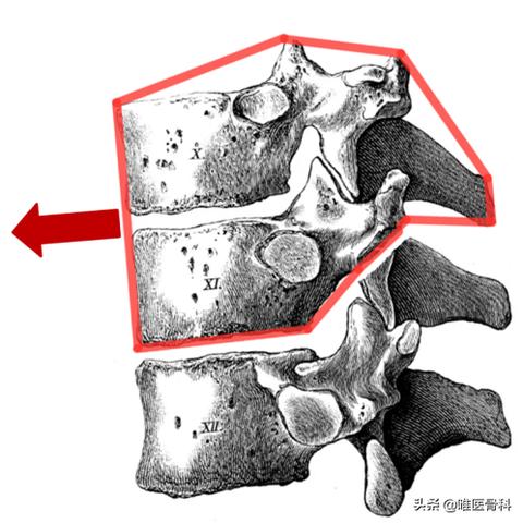 腰椎滑脱的足球运动员叫什么的长尾关键词有什么