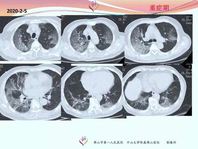孕妇感染新冠状病毒做ct会导致胎儿畸形吗