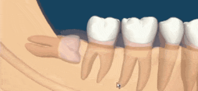 智齿一定要拔吗 智齿一定要拔吗