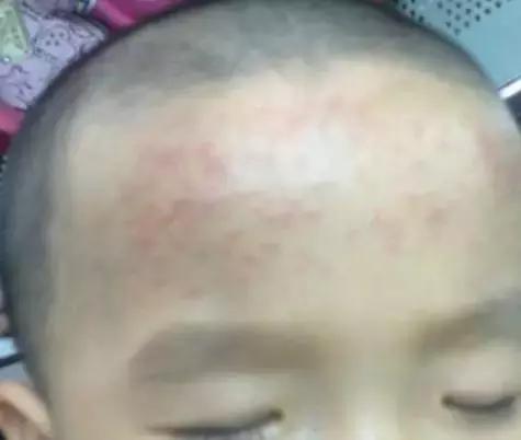 孩子发烧后可以用退热贴吗