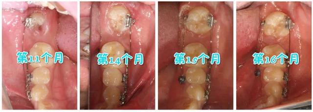 智齿没有咬合牙需要拔吗