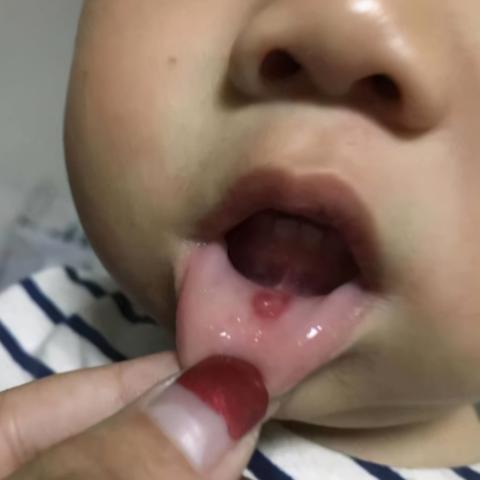 沈阳耳膜穿孔相关长尾关键词有哪些