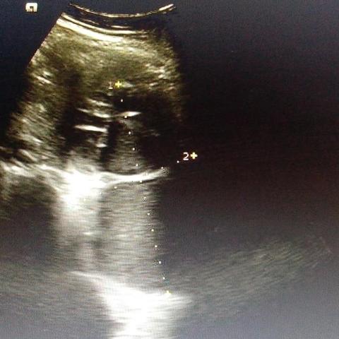 合肥巧克力囊肿相关长尾关键词有哪些