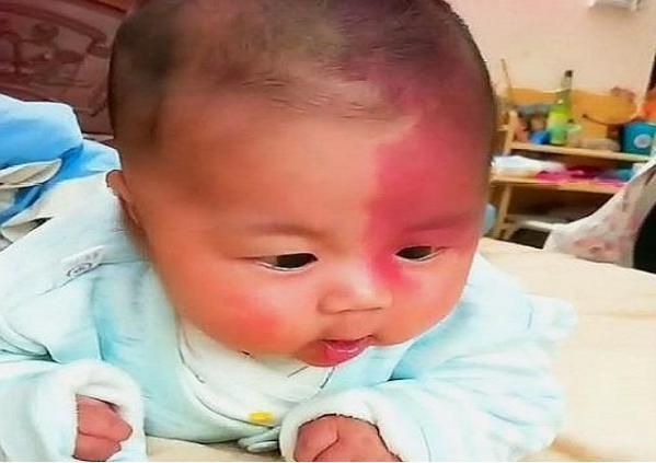 宝宝长胎记和妈妈有关系吗