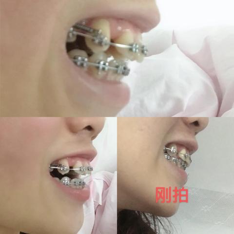 南宁牙齿矫正要多少钱的相关长尾关键词有哪些