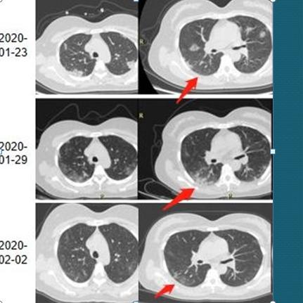 福建冠状病毒肺炎厦门的相关长尾关键词有哪些