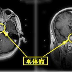 神经性头痛需要做什么检查的长尾关键词有什么