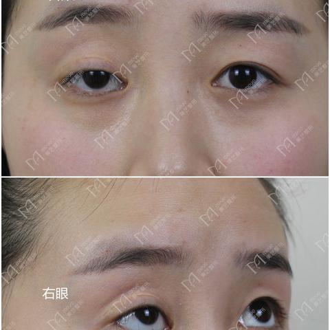 双眼皮下垂做什么手术多少钱的长尾关键词有哪些