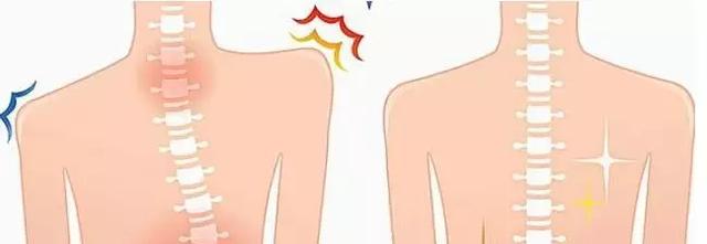 宝宝走路驼背怎么办