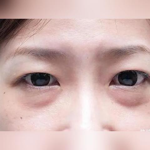关于上海九院 眼袋相关关键词有哪些