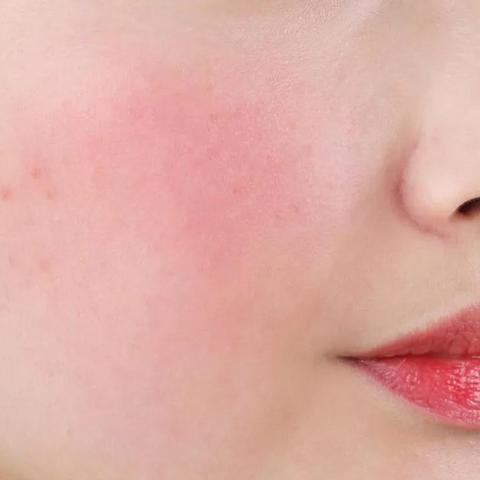 长沙喜玫瑰痤疮相关长尾关键词有哪些