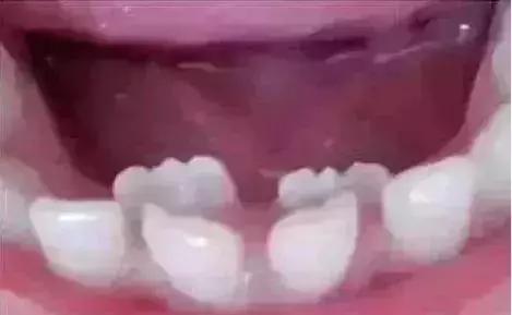 孩子长双排牙要拔吗
