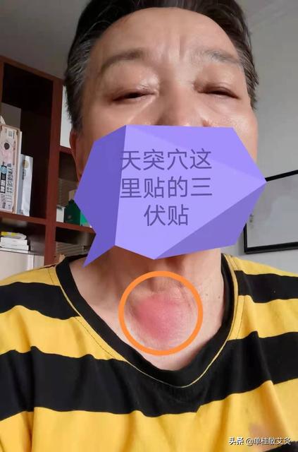 三伏贴忘记揭掉贴的时间长了有危害吗