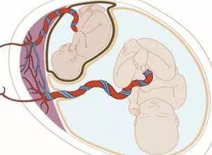 脐带打结对胎儿的影响