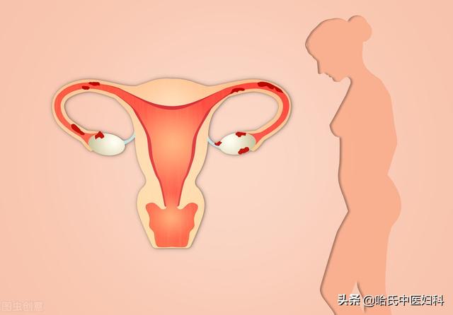 女性子宫肌瘤要不要切子宫