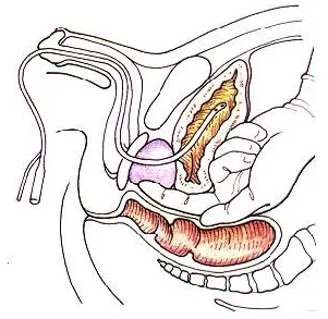 引流品是什么 什么是引流品