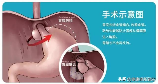 宝宝胃食管反流是什么引起的