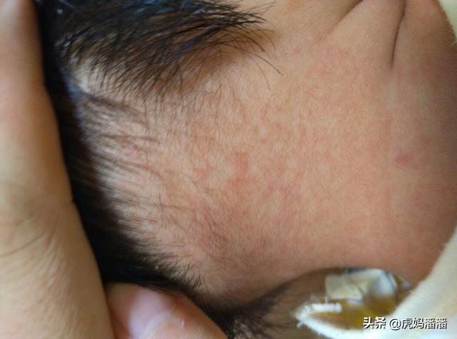 夏季宝宝用什么痱子粉好