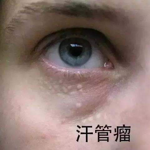 西安汗管瘤激光相关长尾关键词有哪些