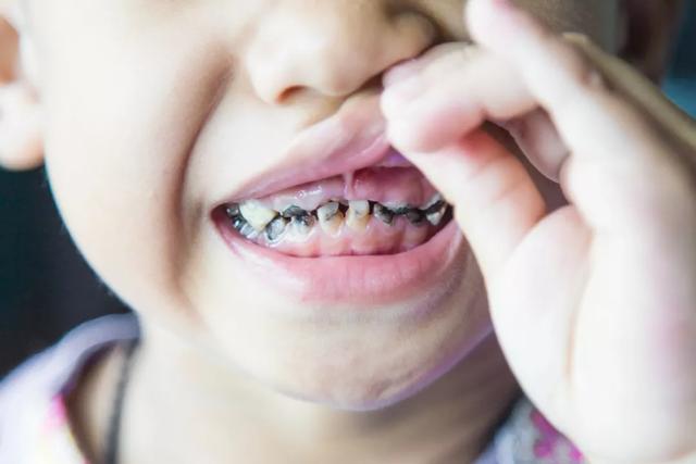 孩子乳牙牙缝特别的大正常吗孩子乳牙牙缝特别大