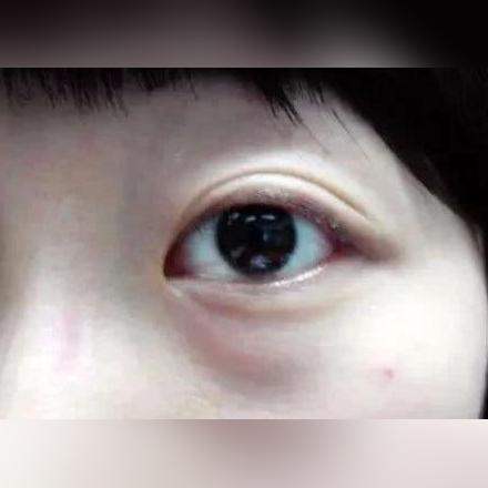 长沙超声波眼袋相关长尾关键词有哪些