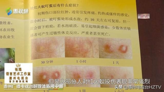 孩子季节交替过敏怎么治