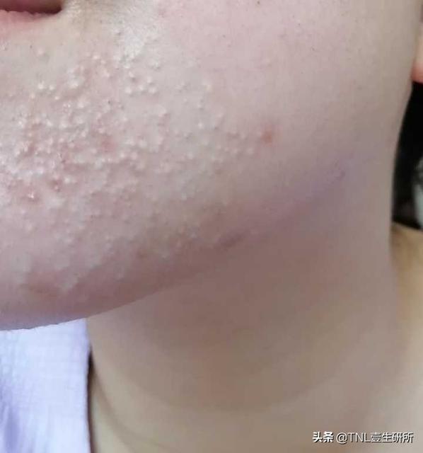 新生儿脸上起红痘还有白点