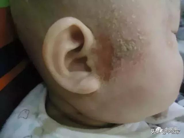 推拿对宝宝湿疹有用吗