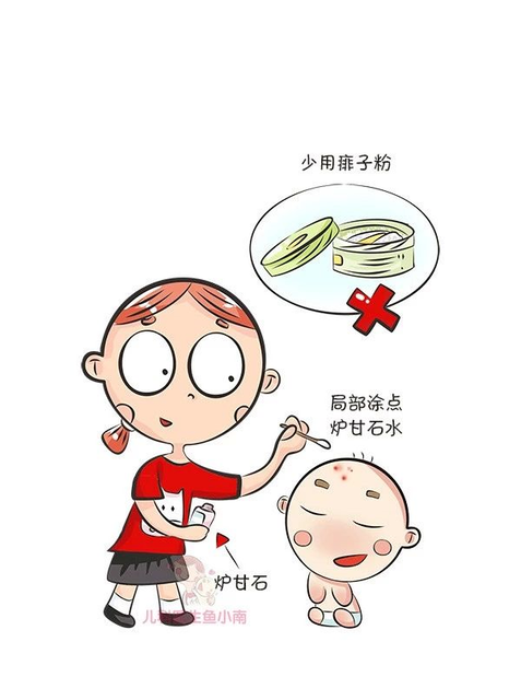 宝宝和孕妇得了荨麻疹能用炉甘石洗剂吗