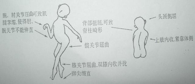 新生儿脑瘫有什么前兆