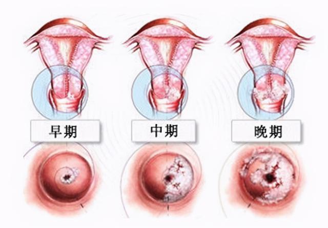 怎么看宫颈糜烂几度