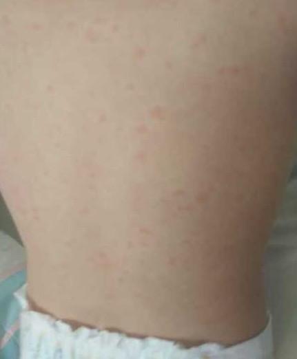 宝宝接种疫苗