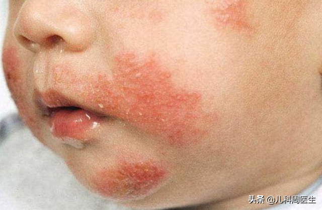 孩子淹脖子了怎么做好得快