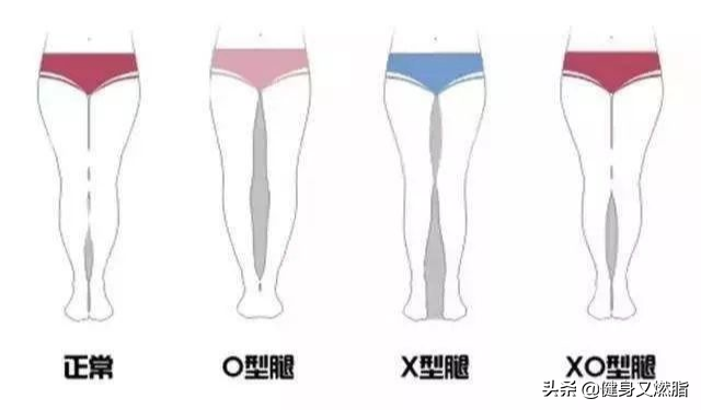 孩子站得早会变O/X型腿吗