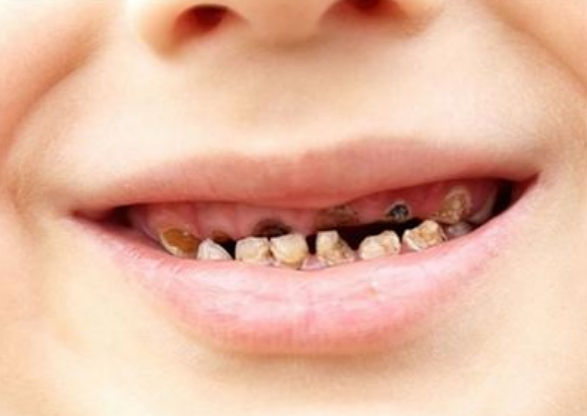 给孩子保护牙齿从什么时候开始好
