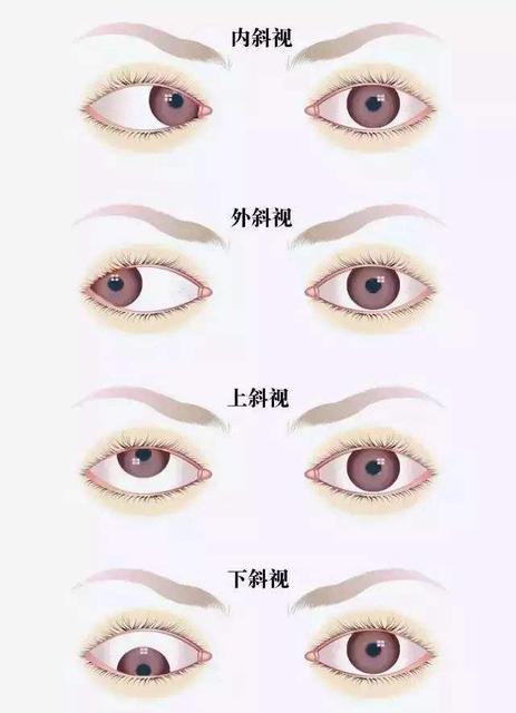 医生表示近视无法治愈是怎么回事