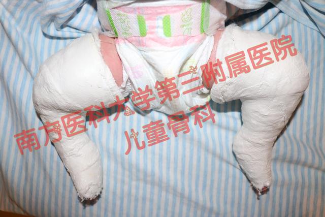 什么是内翻足