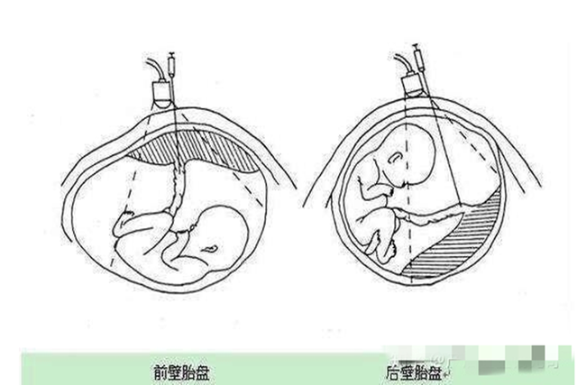怀孕胎盘前壁后壁有什么区别