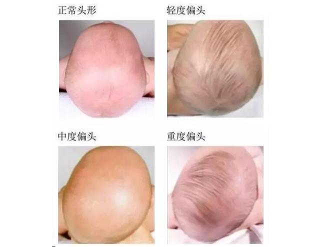 新生儿歪头睡是正常的吗