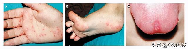 宝宝手足口病会不会很痒