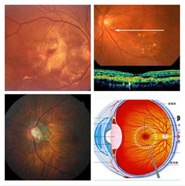 高度近视有治愈的可能性吗