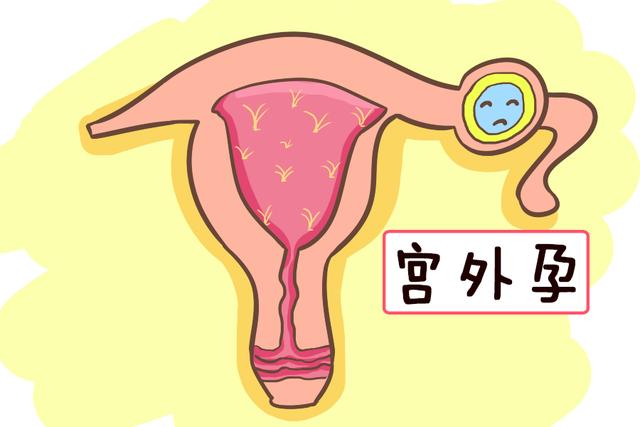 宫外孕有哪些表现及早期症状
