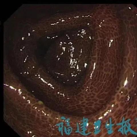 福建肠子怎么样去苦