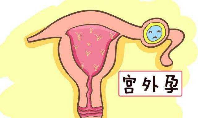 宫颈妊娠属于宫外孕吗