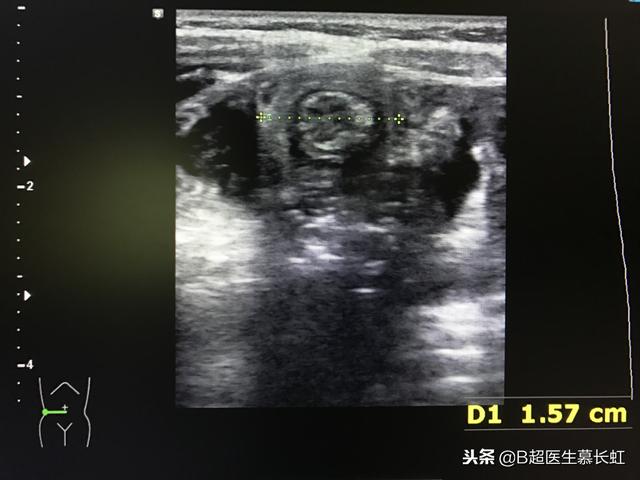 孩子突然肚子痛是肠套叠吗