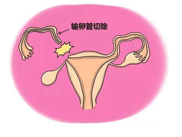 宫外孕怎么办