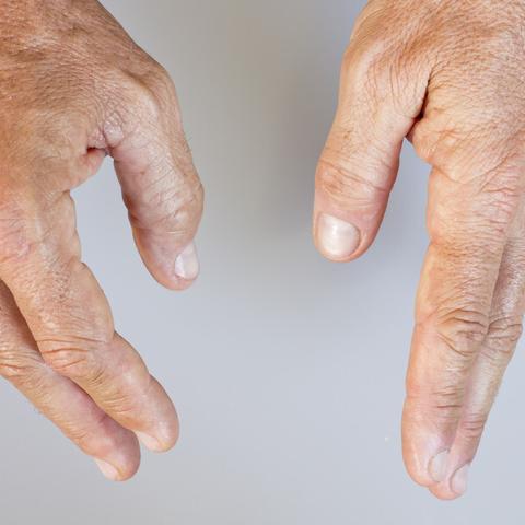 【甲胺,甲胺蝶呤片作用】 【甲胺,甲胺蝶呤片作用】