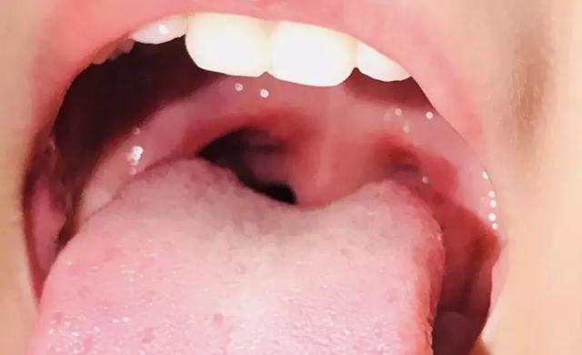 为什么疱疹性咽峡炎期间不能打疫苗
