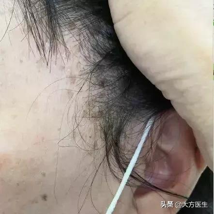 激光养生针济南专卖店相关长尾关键词有哪些